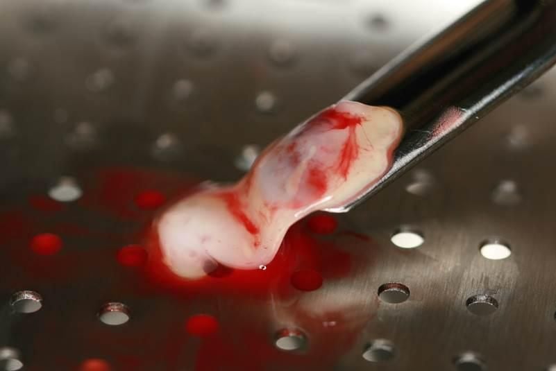 New Dent PRF Processing Box