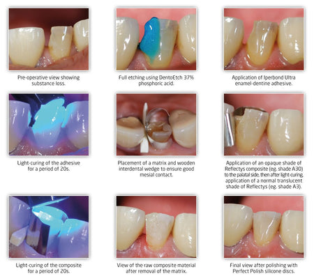 Itena Reflectys Anterior and Posterior Composite Refill 4 g