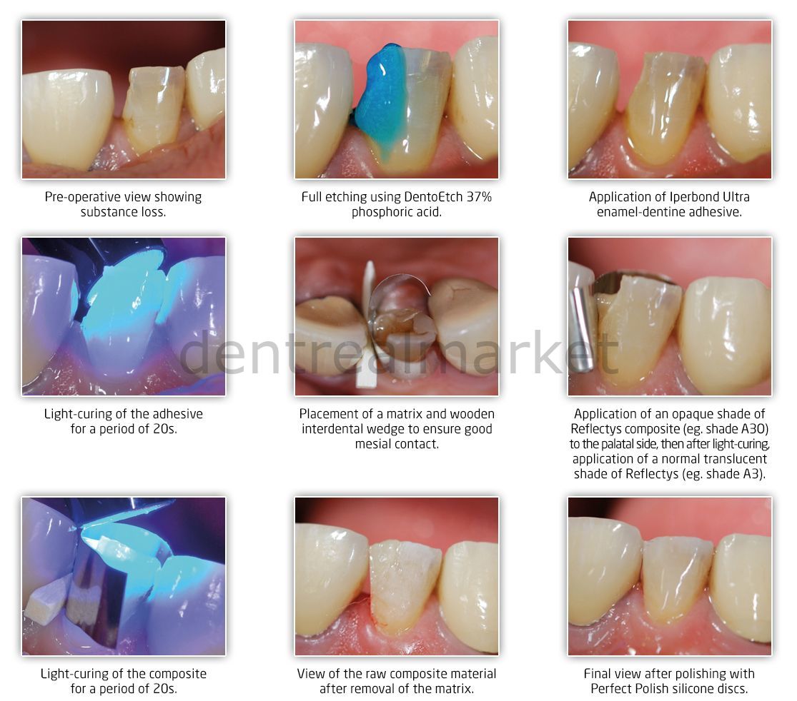 Itena Reflectys Universal Composite Capsule 0.25 g