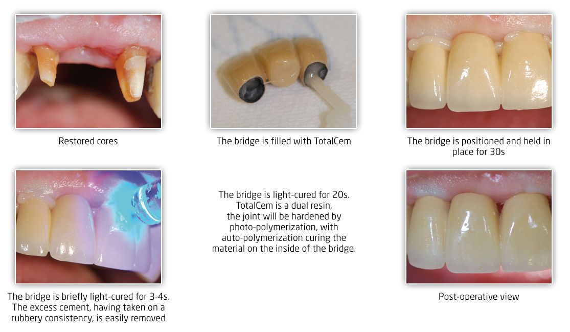 Itena TotalCem Resin-Based Cement Refill 8 g