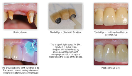 Itena TotalCem Resin-Based Cement Refill 8 g