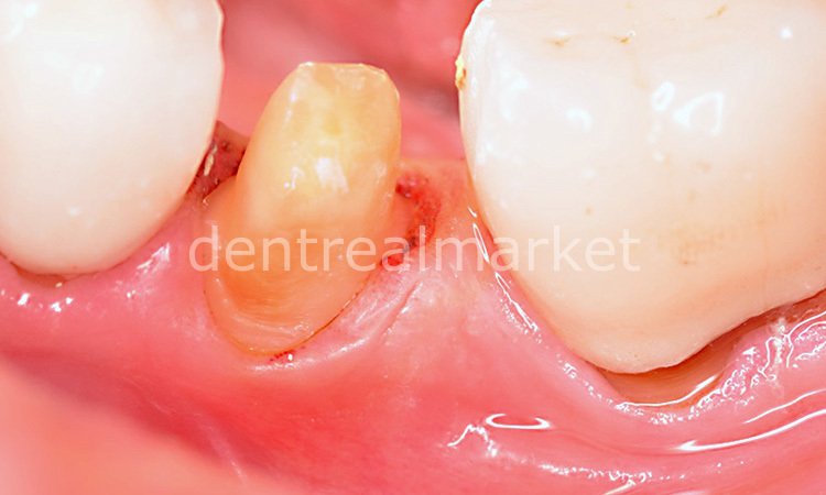 Sedenta Gingiva Gen Retraction Paste