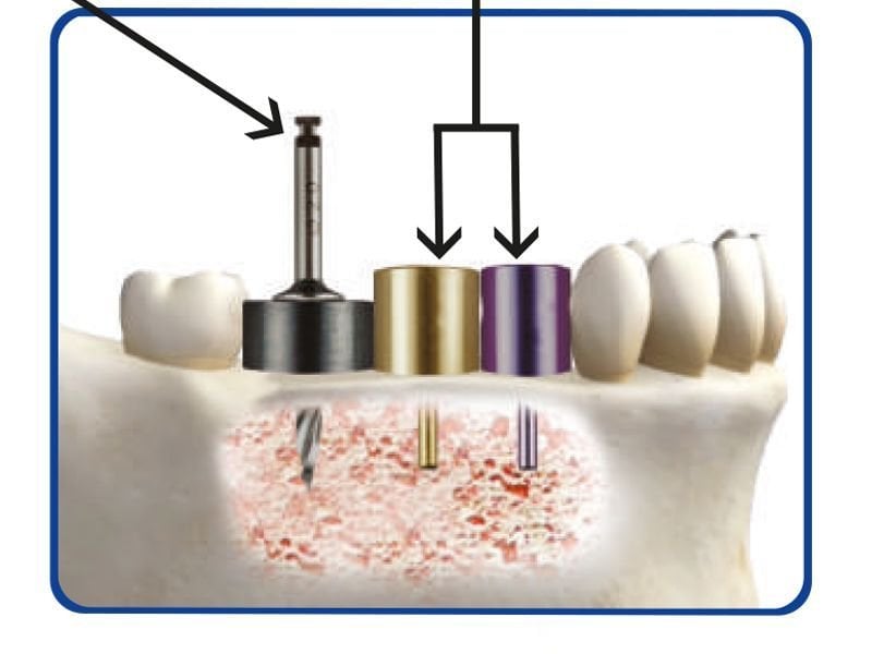 Surgident Implant Placement Kit SD-Aqua Toca