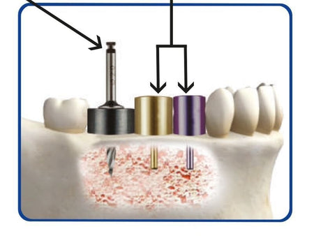 Surgident Implant Placement Kit SD-Aqua Toca