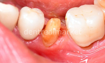 Sedenta Gingiva Gen Retraction Paste