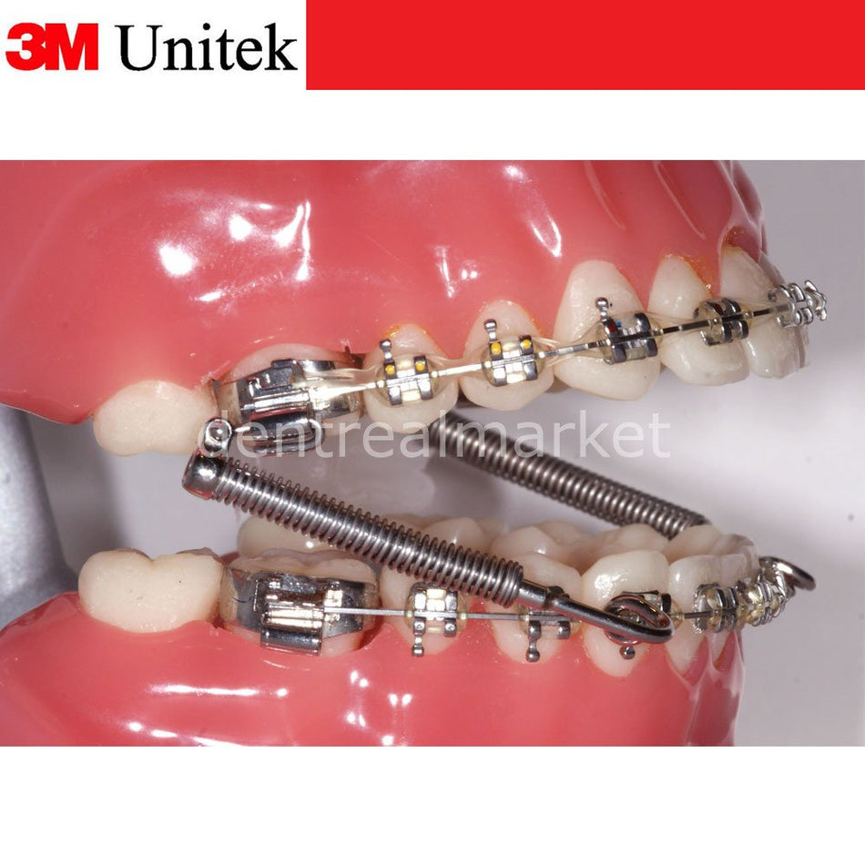 3M Unitek Forsus Single Patient Kit