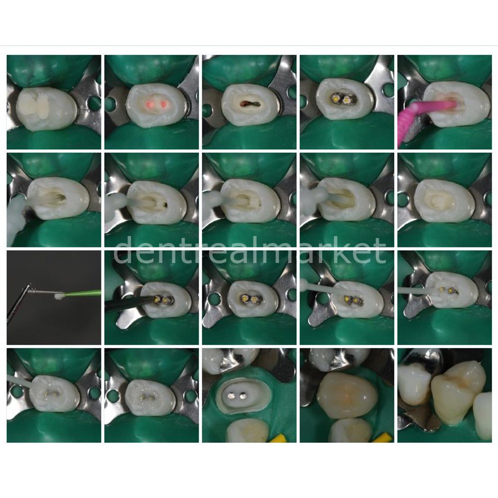 Kettenbach Visalys Core Build-Up Material