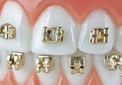 American Orthodontics Forever Gold Metal Bracket