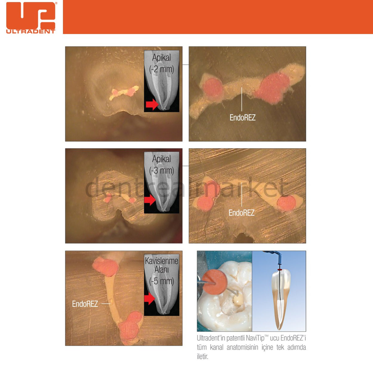 Ultradent EndoREZ Refill Root Canal Sealer