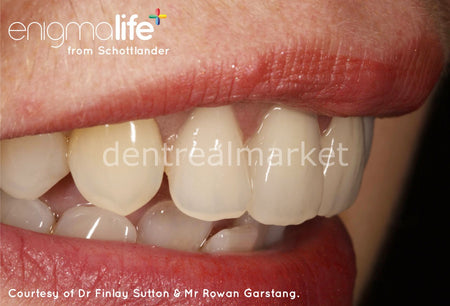 Schottlander Enigmalife+ Nano-Hybrid Composite Denture Teeth — 28-Set