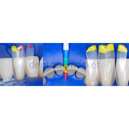 Bioclear Intro Black Triangle (BT) Matrix Set