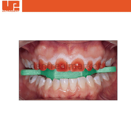 Ultradent IsoBlock Bite Block