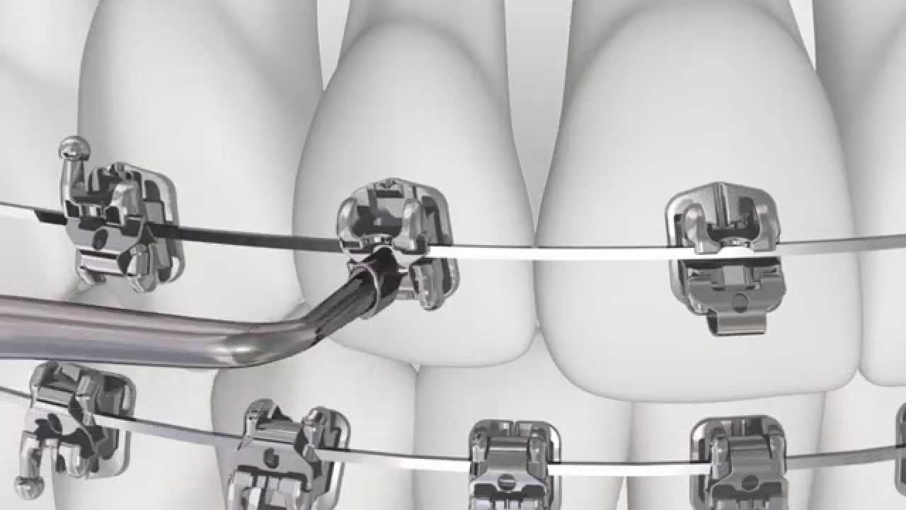 American Orthodontics Empower SL Self-Ligating Metal Bracket