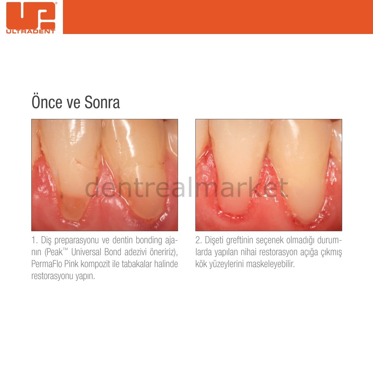 Ultradent PermaFlo Pink Kit - Gingiva-Shade Composite