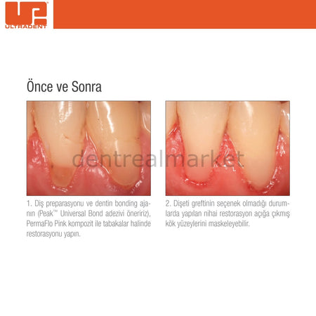 Ultradent PermaFlo Pink Kit - Gingiva-Shade Composite