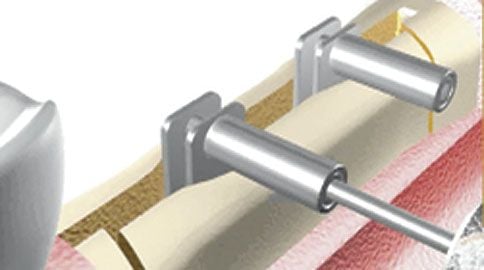 Meisinger Crest Control Basic Bone Expansion Set