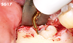 NSK Piezo Surgery Tips – Extraction Series