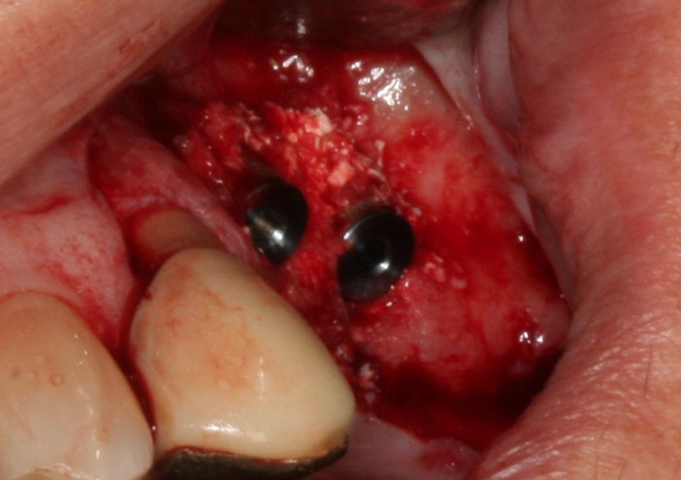 Resorba Parasorb Collagene Cone - Extraction Socket Protection