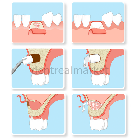 Resorba Parasorb Resodont Forte - Collagen Membrane 64*25 mm