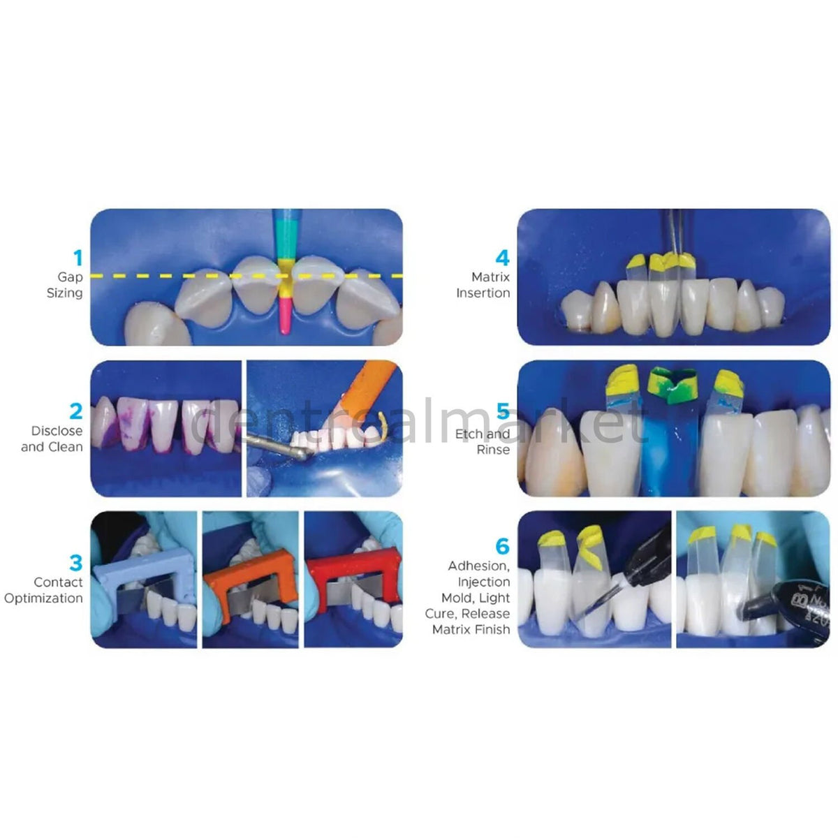 Bioclear TruContact Kit - Interproximal Saw and Sander Set