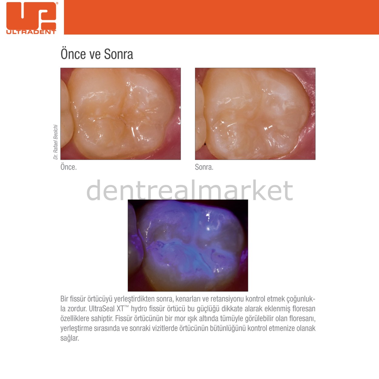 Ultradent UltraSeal XT Hydro Pit and Fissure Sealant Refill