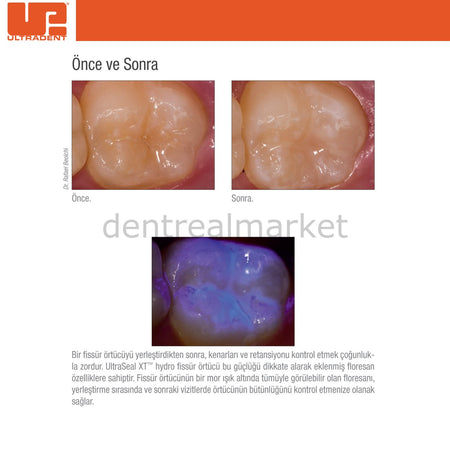 Ultradent UltraSeal XT Hydro Pit and Fissure Sealant Refill