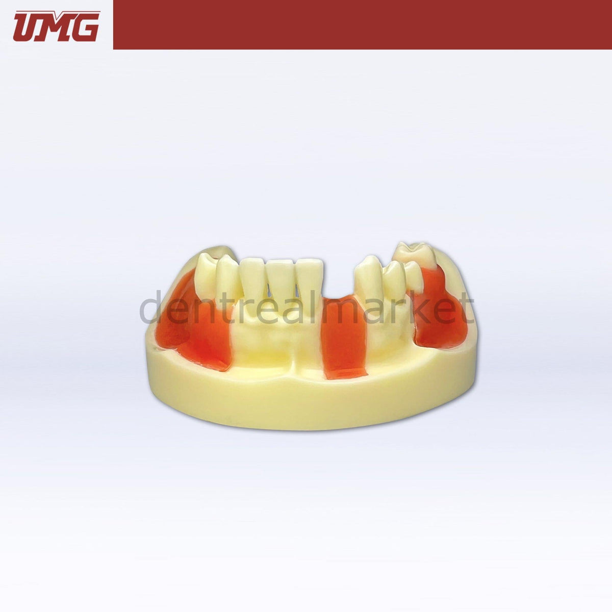 Umgr Ris Umg Dental - Umg Model Implant Training Model With Gingiva – DentrealStore