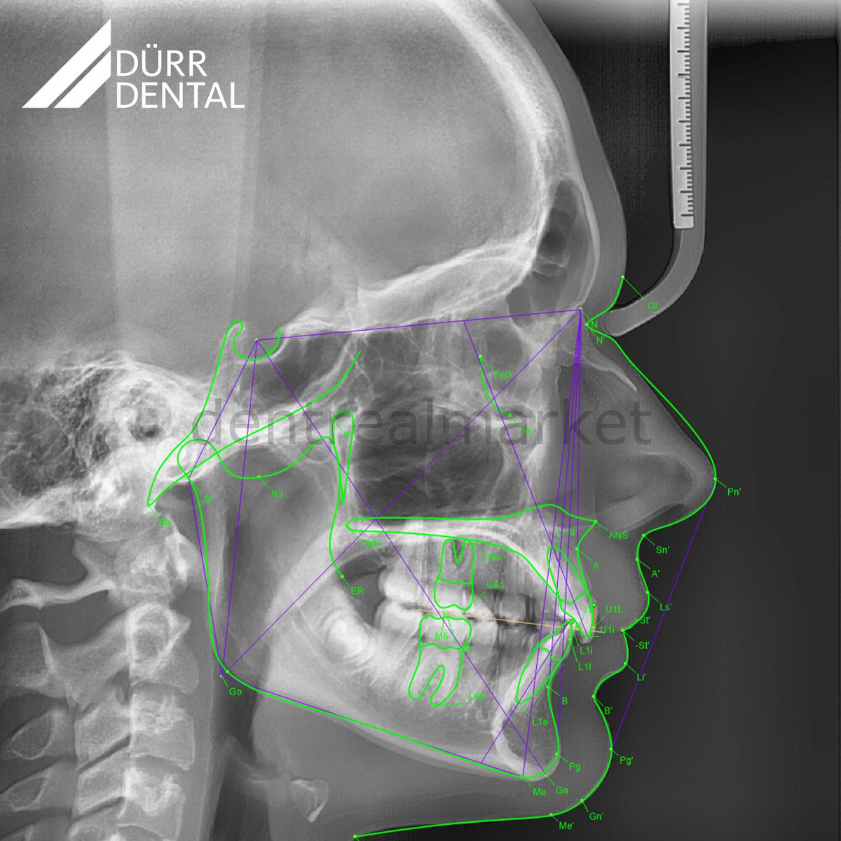 Durr Dental VistaPano S Panoramic + Ceph X-Ray