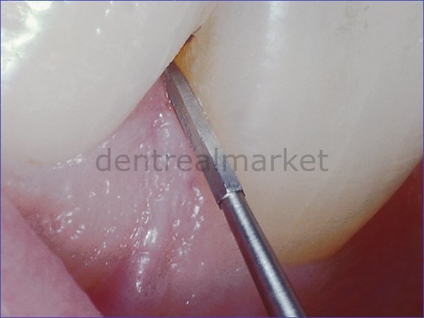 DentrealStore - Frank Dental Tungsten Carbide Perio Bur - Periodontal Bur 747L
