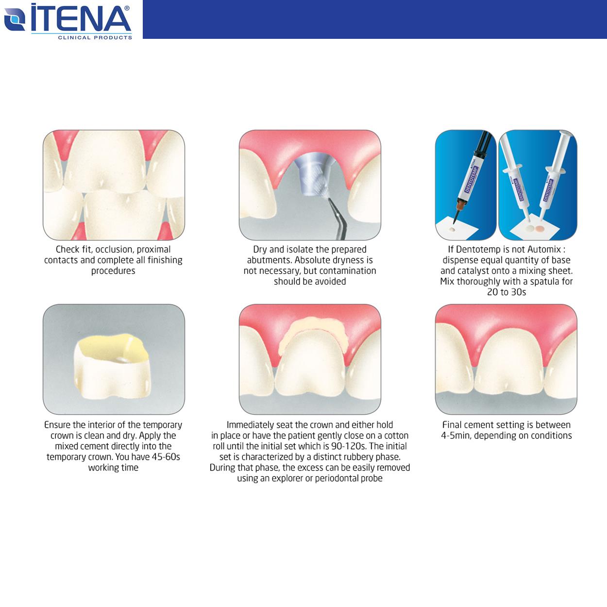 DentrealStore - Itena Dentotemp Long term temporary cement - Special implant - 2 Pcs