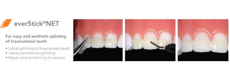 DentrealStore - Gc Dental EverStick NET - Fibre Reinforcement for Labial Splinting
