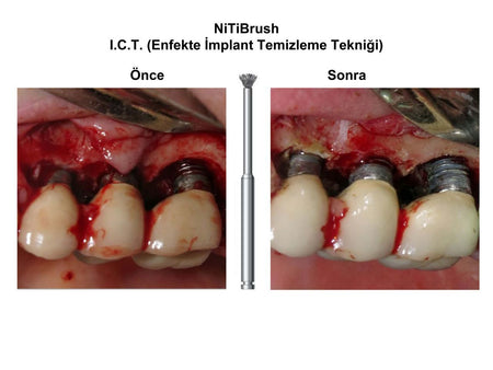 DentrealStore - Dentkonsept Nitibrush Peri-Implantitis Bur Set - 4 Pcs