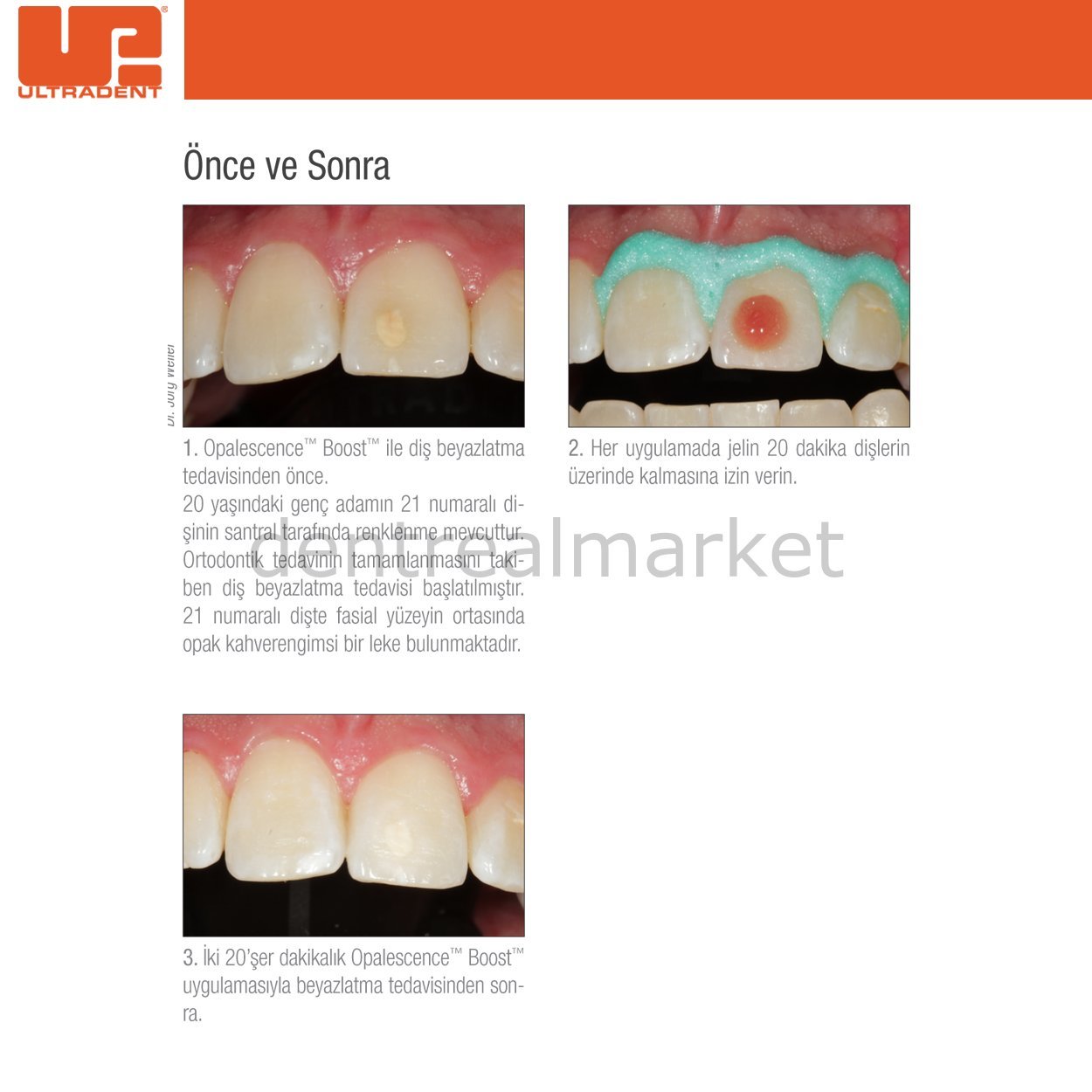 DentrealStore - Ultradent Ultradent - Opalescence Boost PF %40HP - in Office Dental Whitening - 10 Patient Kits
