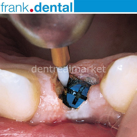 DentrealStore - Frank Dental Soft Tissue Gingiva Trimmer Burs - Ceramic Gingiva Bur - GT48L - STT249