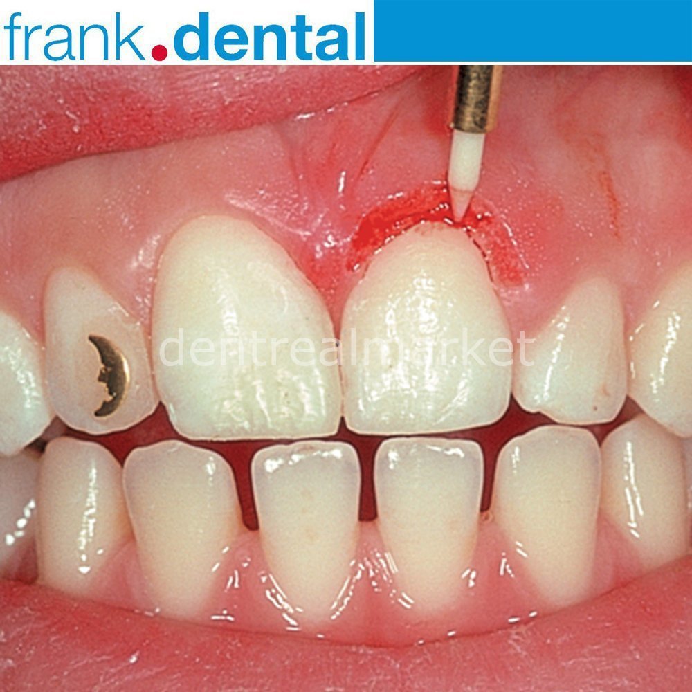 DentrealStore - Frank Dental Soft Tissue Gingiva Trimmer Burs - Ceramic Gingiva Bur - GT48L - STT249