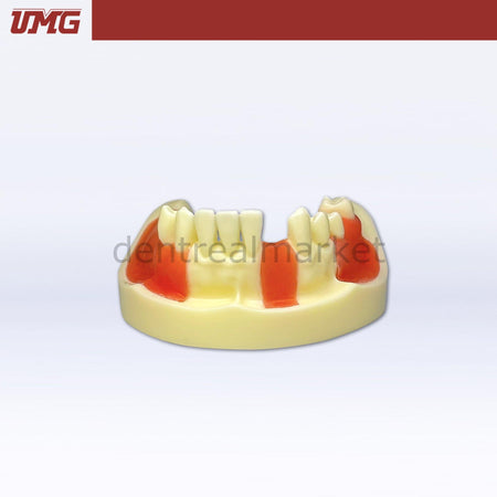 DentrealStore - Umg Dental Umg Model Implant Training Model With Gingiva